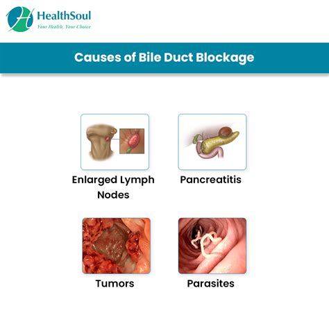 Biliary Obstruction: Causes, Symptoms, Treatment,。